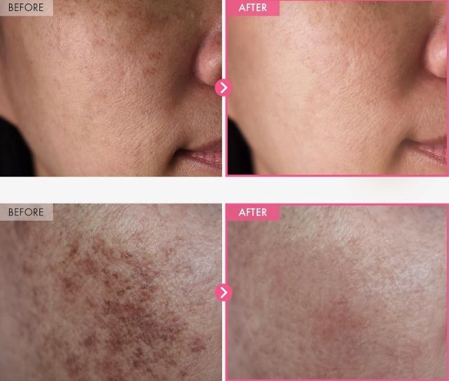 Crème Arbutine 7.0 + TXA 4.0
